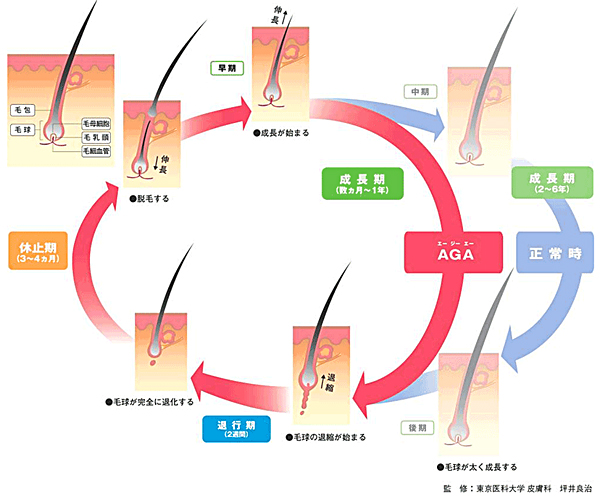 AGAになると成長期が短くなり髪が細く短くなります。