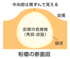 しこり おでき 皮膚のできもの の治療は必要 皮膚科医による解説 江戸川橋皮フ科クリニック 文京区 皮膚科 小児皮膚科 アレルギー科